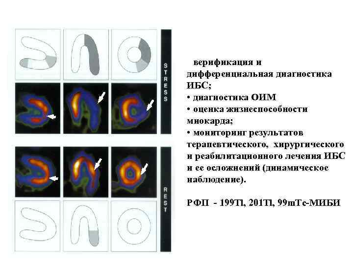 Перфузионная сцинтиграфия миокарда Возможности метода: • верификация и дифференциальная диагностика ИБС; • диагностика ОИМ