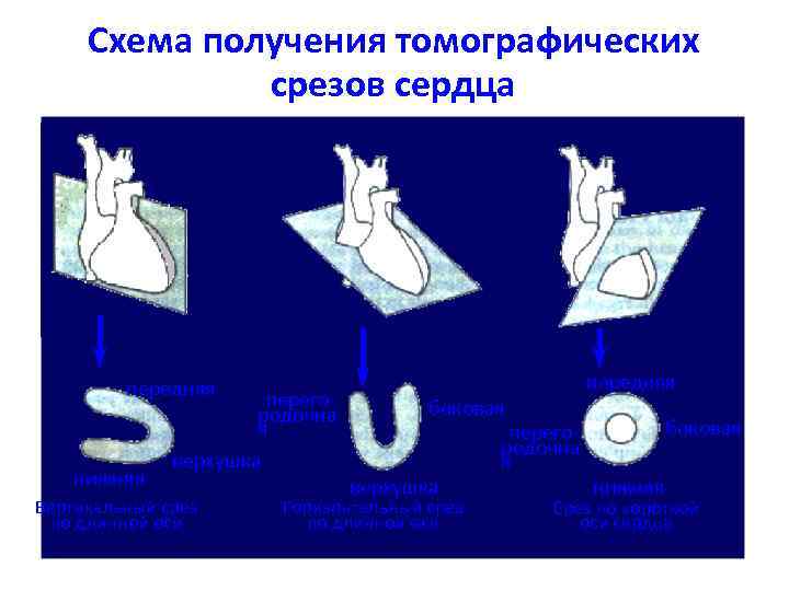 Схема получения томографических срезов сердца передняя нижняя перегородочна я верхушка Вертикальный срез по длинной