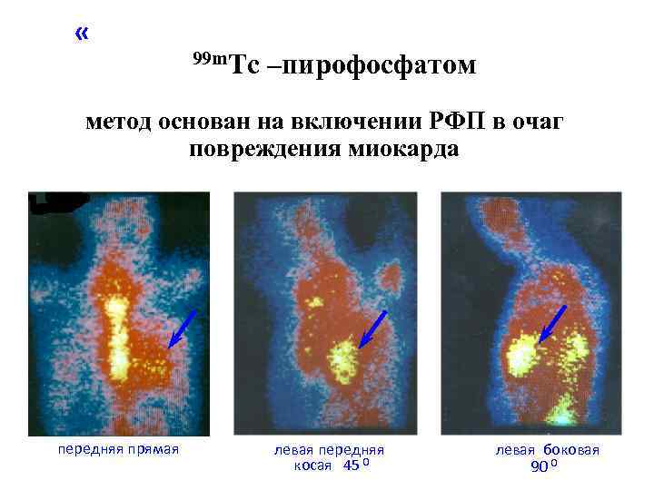  «Позитивная» сцинтиграфия миокарда с 99 m. Tc –пирофосфатом метод основан на включении РФП