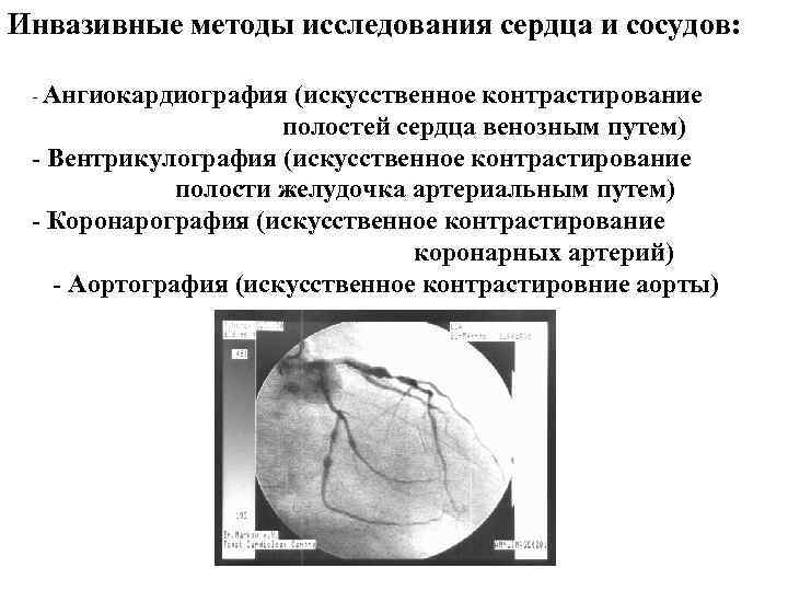 Инвазивные методы исследования сердца и сосудов: - Ангиокардиография (искусственное контрастирование полостей сердца венозным путем)