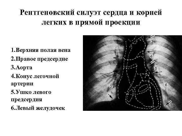 Рентгеновский силуэт сердца и корней легких в прямой проекции 1. Верхняя полая вена 2.