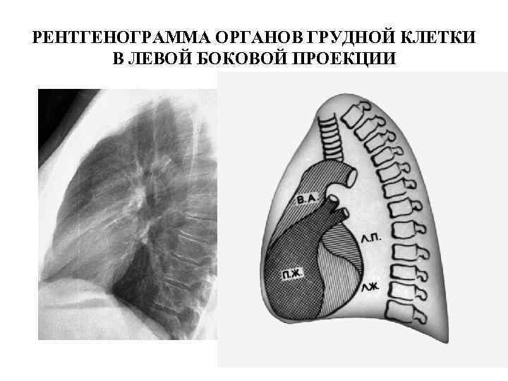 РЕНТГЕНОГРАММА ОРГАНОВ ГРУДНОЙ КЛЕТКИ В ЛЕВОЙ БОКОВОЙ ПРОЕКЦИИ 