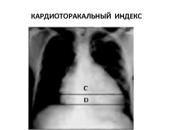 КАРДИОТОРАКАЛЬНЫЙ ИНДЕКС 