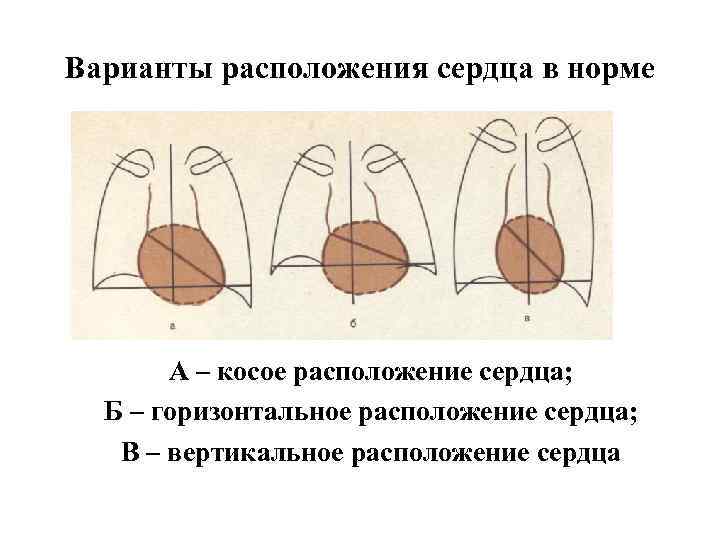 Варианты расположения сердца в норме А – косое расположение сердца; Б – горизонтальное расположение