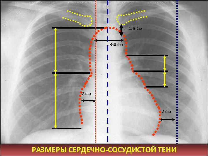 1. 5 см 3 -4 см 2 см РАЗМЕРЫ СЕРДЕЧНО-СОСУДИСТОЙ ТЕНИ 