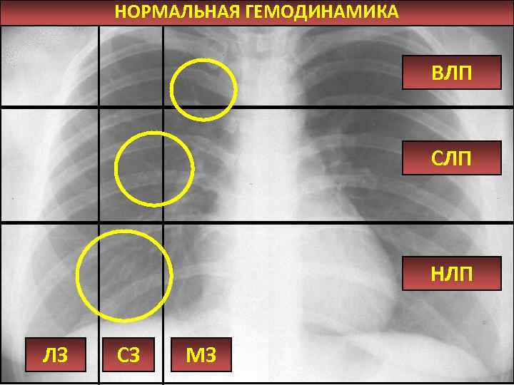 НОРМАЛЬНАЯ ГЕМОДИНАМИКА ВЛП СЛП НЛП ЛЗ СЗ МЗ 