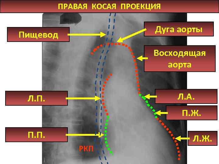 ПРАВАЯ КОСАЯ ПРОЕКЦИЯ Дуга аорты Пищевод Восходящая аорта Л. А. Л. П. Ж. П.