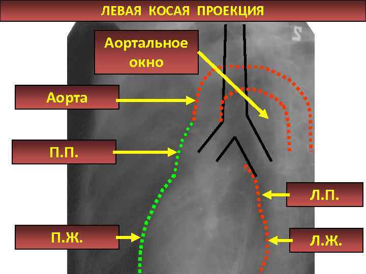 ЛЕВАЯ КОСАЯ ПРОЕКЦИЯ Аортальное окно Аорта П. П. Л. П. П. Ж. Л. Ж.