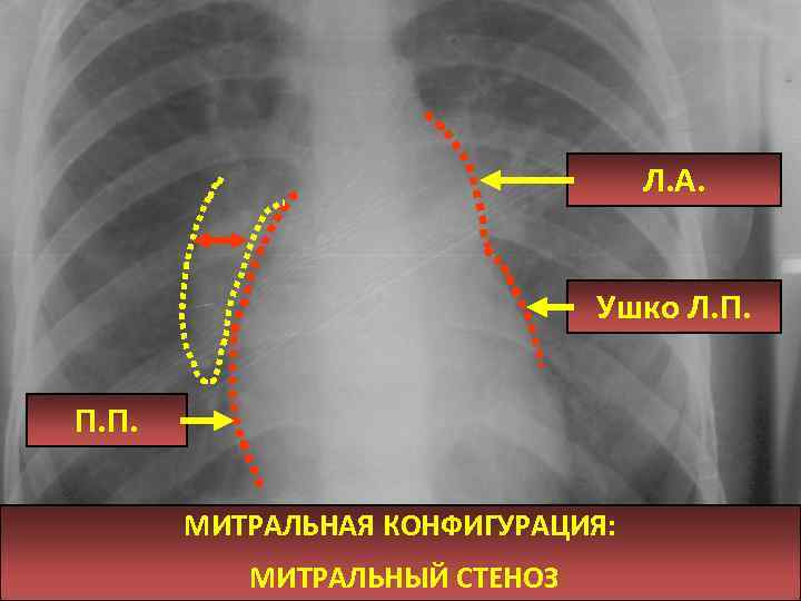 Л. А. Ушко Л. П. П. П. МИТРАЛЬНАЯ КОНФИГУРАЦИЯ: МИТРАЛЬНЫЙ СТЕНОЗ 