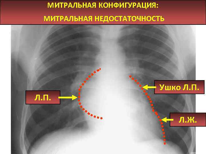 МИТРАЛЬНАЯ КОНФИГУРАЦИЯ: МИТРАЛЬНАЯ НЕДОСТАТОЧНОСТЬ Л. П. Ушко Л. П. Л. Ж. 