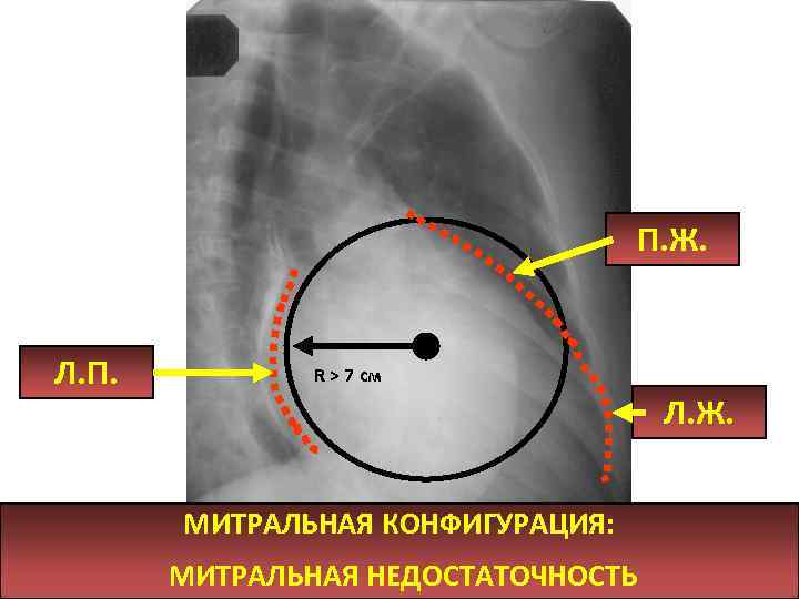 П. Ж. Л. П. R > 7 см Л. Ж. МИТРАЛЬНАЯ КОНФИГУРАЦИЯ: МИТРАЛЬНАЯ НЕДОСТАТОЧНОСТЬ