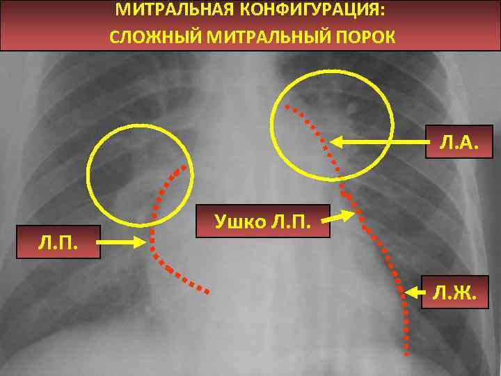 МИТРАЛЬНАЯ КОНФИГУРАЦИЯ: СЛОЖНЫЙ МИТРАЛЬНЫЙ ПОРОК Л. А. Л. П. Ушко Л. П. Л. Ж.