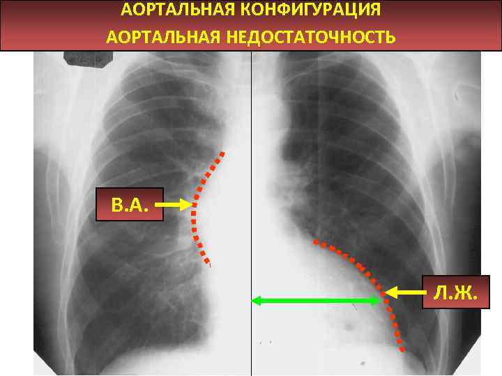 АОРТАЛЬНАЯ КОНФИГУРАЦИЯ АОРТАЛЬНАЯ НЕДОСТАТОЧНОСТЬ В. А. Л. Ж. 