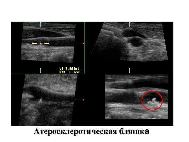 Атеросклеротическая бляшка 