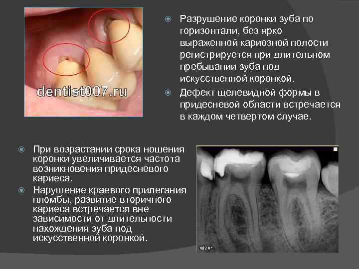 Разрушение коронки зуба по горизонтали, без ярко выраженной кариозной полости регистрируется при длительном пребывании