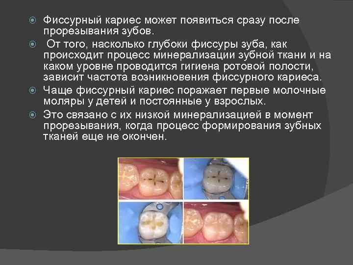 Фиссурный кариес может появиться сразу после прорезывания зубов. От того, насколько глубоки фиссуры зуба,