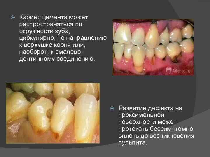  Кариес цемента может распространяться по окружности зуба, циркулярно, по направлению к верхушке корня