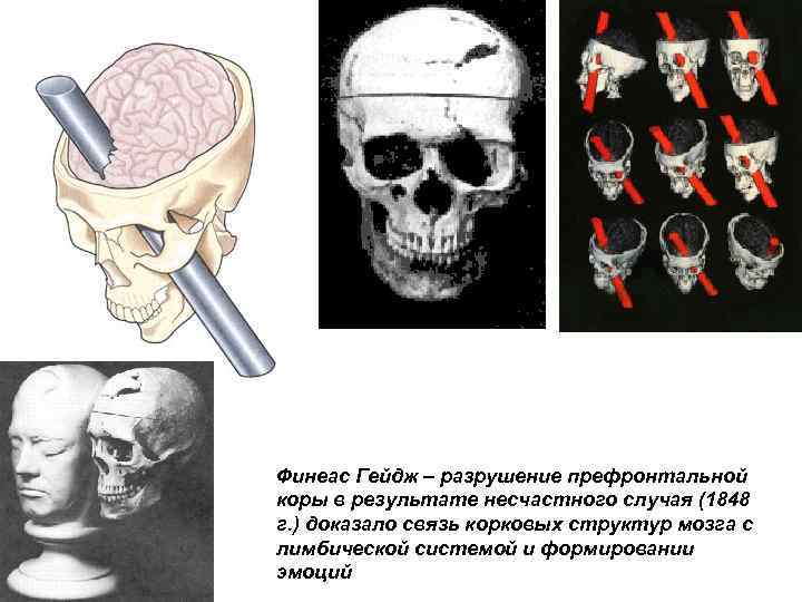 Финеас Гейдж – разрушение префронтальной коры в результате несчастного случая (1848 г. ) доказало