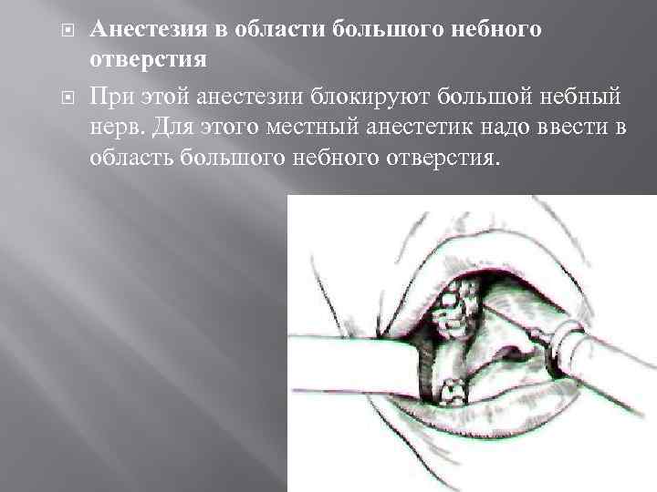  Анестезия в области большого небного отверстия При этой анестезии блокируют большой небный нерв.