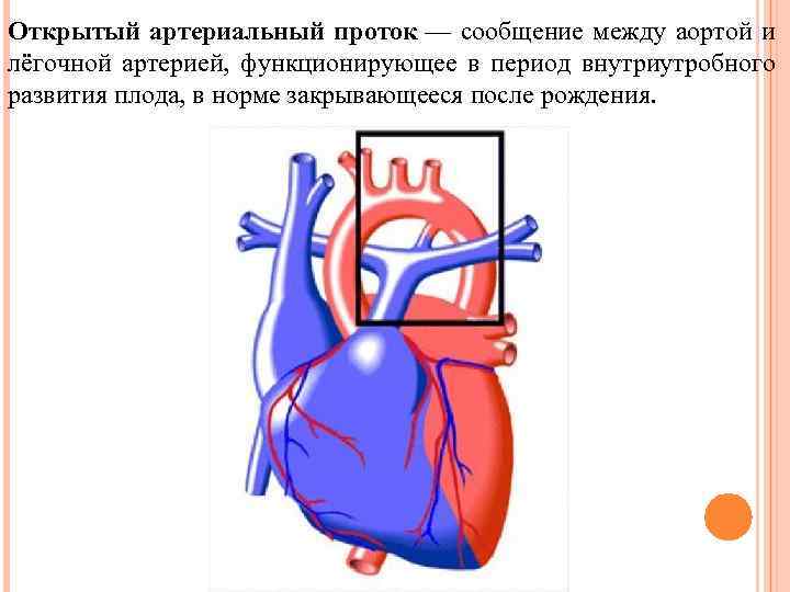 Открытый артериальный проток — сообщение между аортой и лёгочной артерией, функционирующее в период внутриутробного