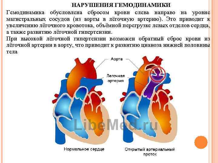 НАРУШЕНИЯ ГЕМОДИНАМИКИ Гемодинамика обусловлена сбросом крови слева направо на уровне магистральных сосудов (из аорты