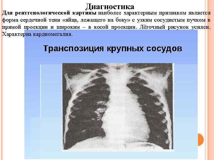 Диагностика Для рентгенологической картины наиболее характерным признаком является форма сердечной тени «яйца, лежащего на