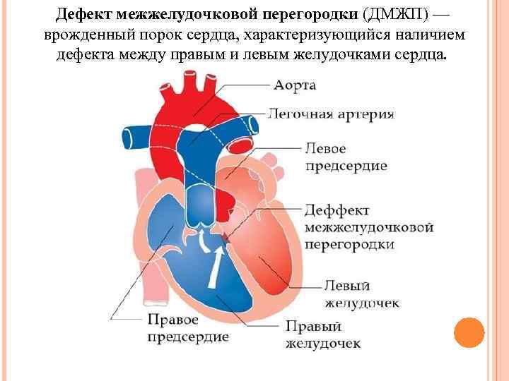 Дефект межжелудочковой перегородки (ДМЖП) — врожденный порок сердца, характеризующийся наличием дефекта между правым и