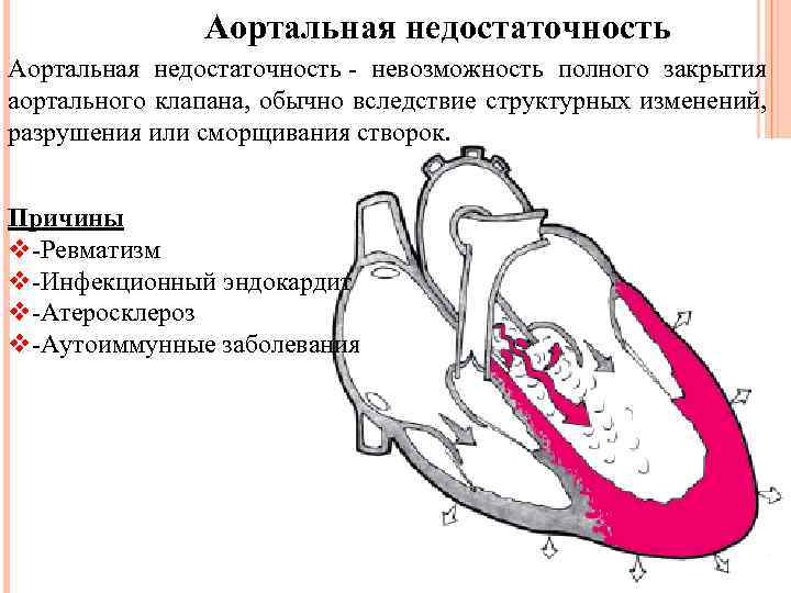 Аортальная недостаточность - невозможность полного закрытия аортального клапана, обычно вследствие структурных изменений, разрушения или