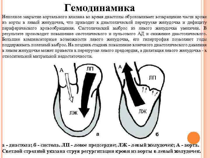 Схема гемодинамики при пороках сердца