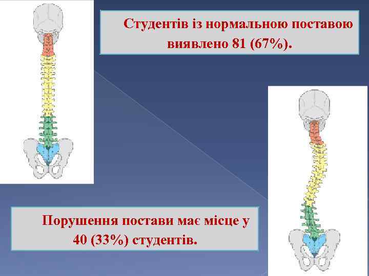 Студентів із нормальною поставою виявлено 81 (67%). Порушення постави має місце у 40 (33%)