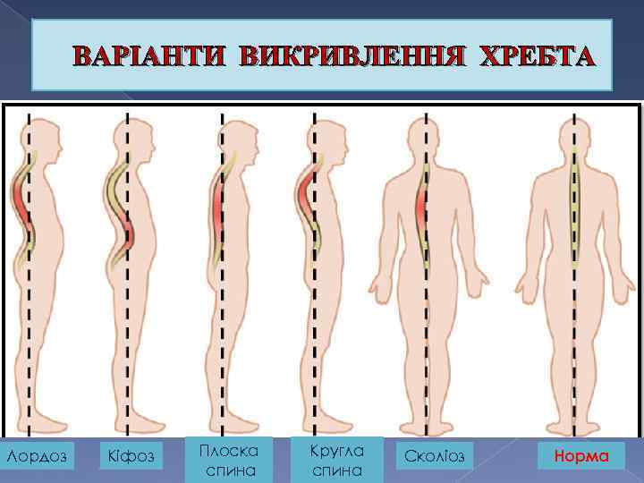 ВАРІАНТИ ВИКРИВЛЕННЯ ХРЕБТА Лордоз Кіфоз Плоска спина Кругла спина Сколіоз Норма 