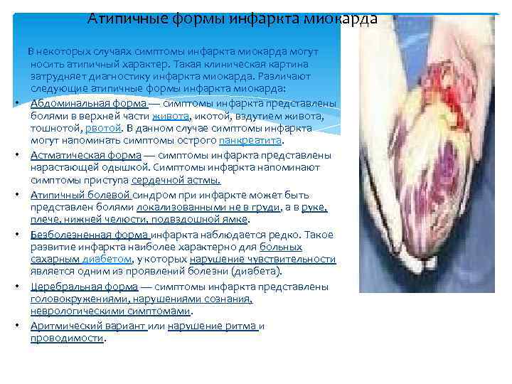 Атипичные формы инфаркта миокарда В некоторых случаях симптомы инфаркта миокарда могут носить атипичный характер.