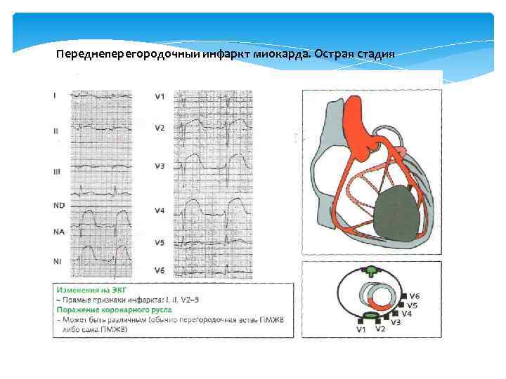 Переднеперегородочныи инфаркт миокарда. Острая стадия 