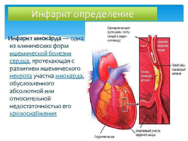 Инфаркт определение Инфаркт миока рда — одна из клинических форм ишемической болезни сердца, протекающая