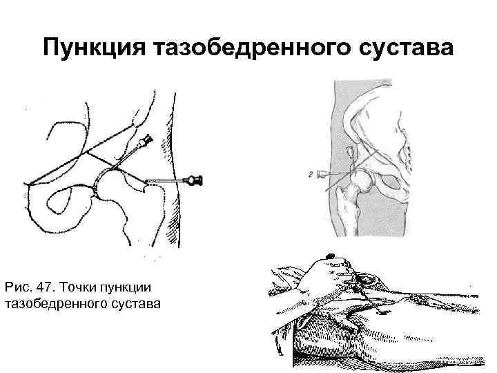 Бедренная пункция. Пункция тазобедренного сустава точки пункции. Ориентиры пункции тазобедренного сустава. Пункция тазобедренного сустава техника. Пункция бедренного сустава топографическая анатомия.