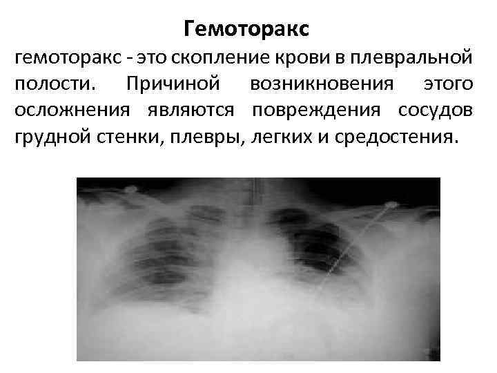 Пневмоторакс гемоторакс презентация