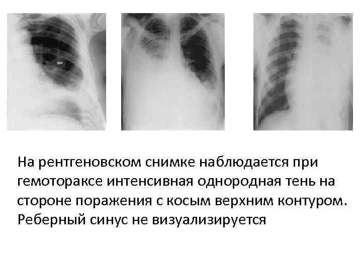 На рентгеновском снимке наблюдается при гемотораксе интенсивная однородная тень на стороне поражения с косым