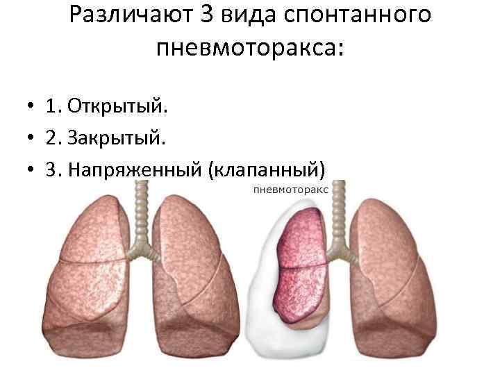 Различают 3 вида спонтанного пневмоторакса: • 1. Открытый. • 2. Закрытый. • 3. Напряженный