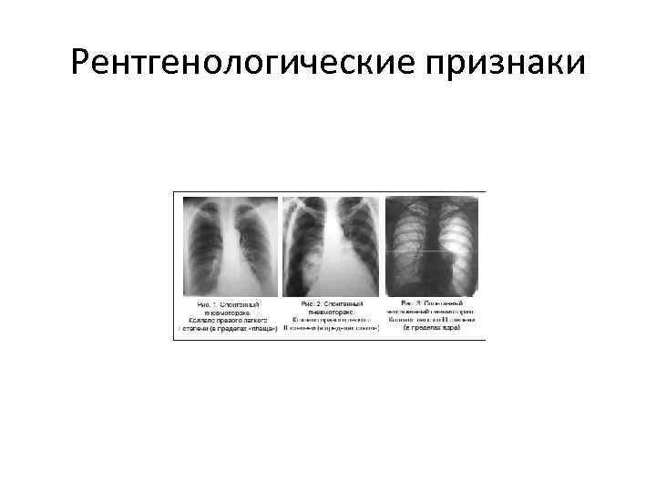 Рентгенологические признаки 