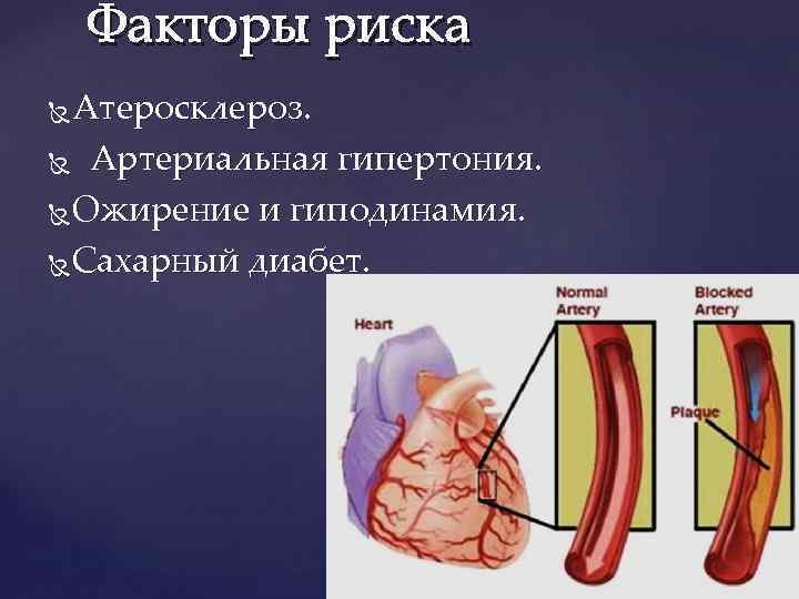 Факторы риска Атеросклероз. Артериальная гипертония. Ожирение и гиподинамия. Сахарный диабет. 