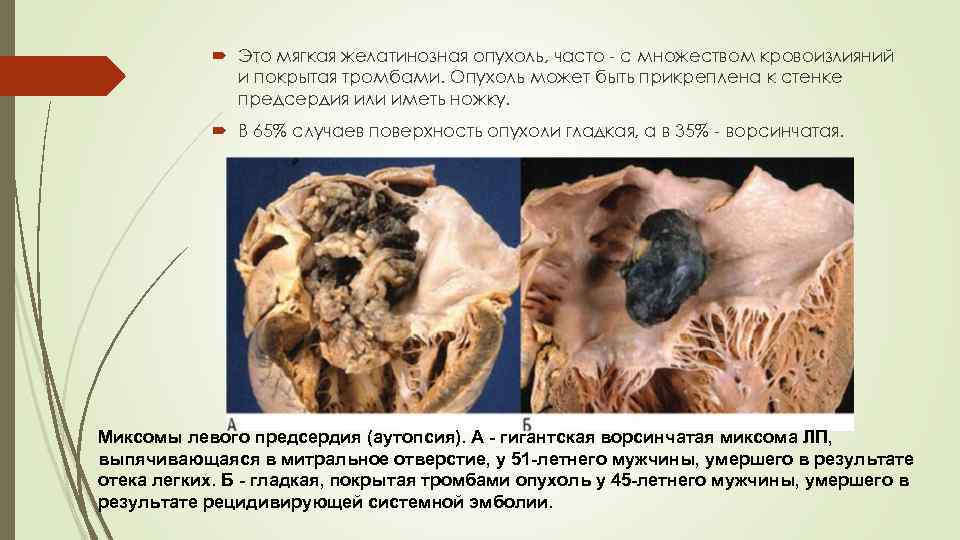  Это мягкая желатинозная опухоль, часто - с множеством кровоизлияний и покрытая тромбами. Опухоль