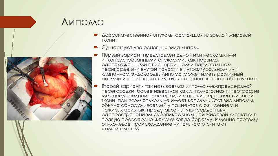 Липома Доброкачественная опухоль, состоящая из зрелой жировой ткани. Существуют два основных вида липом. Первый