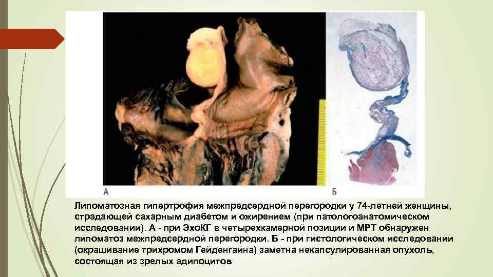 Липоматозная гипертрофия межпредсердной перегородки у 74 -летней женщины, страдающей сахарным диабетом и ожирением (при