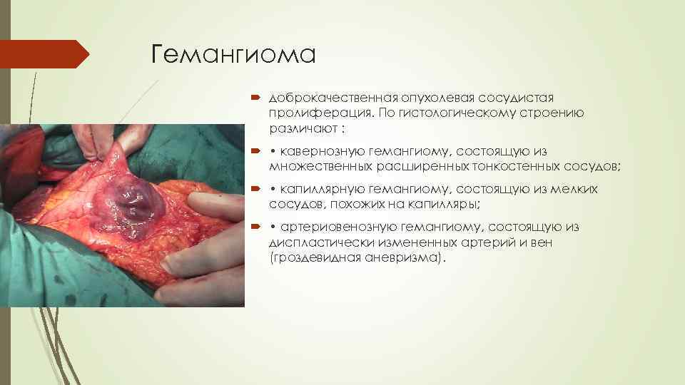 Гемангиома доброкачественная опухолевая сосудистая пролиферация. По гистологическому строению различают : • кавернозную гемангиому, состоящую
