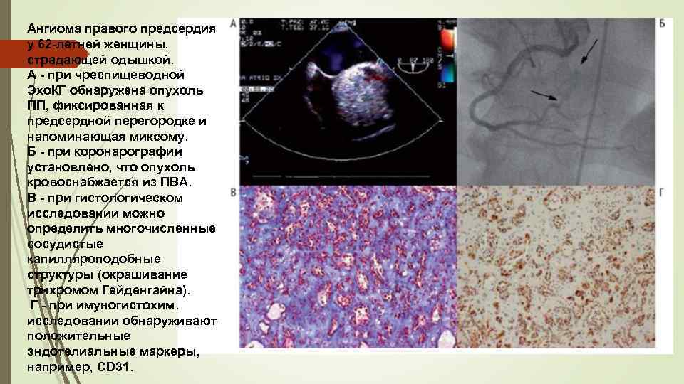 Ангиома правого предсердия у 62 -летней женщины, страдающей одышкой. А - при чреспищеводной Эхо.