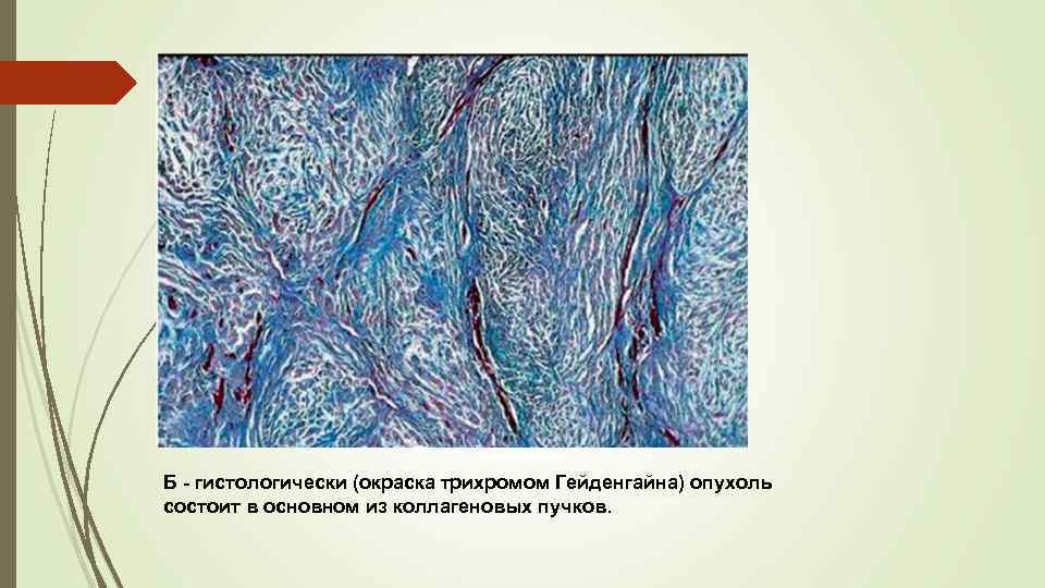 Б - гистологически (окраска трихромом Гейденгайна) опухоль состоит в основном из коллагеновых пучков. 