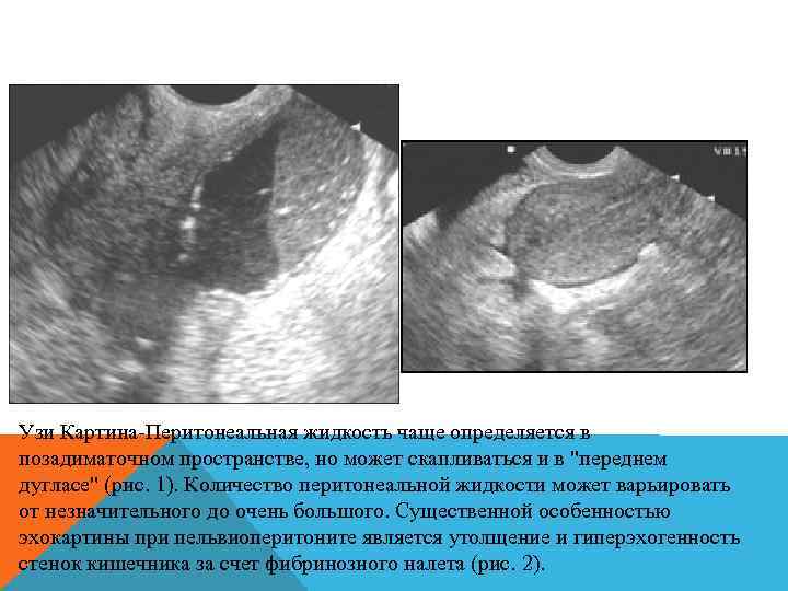 Узи Картина-Перитонеальная жидкость чаще определяется в позадиматочном пространстве, но может скапливаться и в "переднем