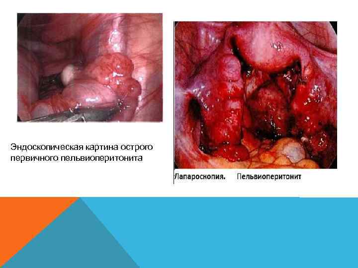 Эндоскопическая картина острого первичного пельвиоперитонита 