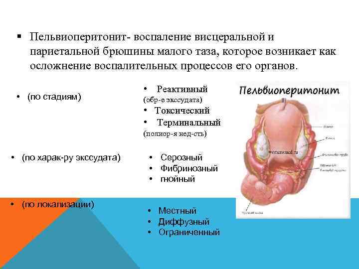 § Пельвиоперитонит- воспаление висцеральной и париетальной брюшины малого таза, которое возникает как осложнение воспалительных