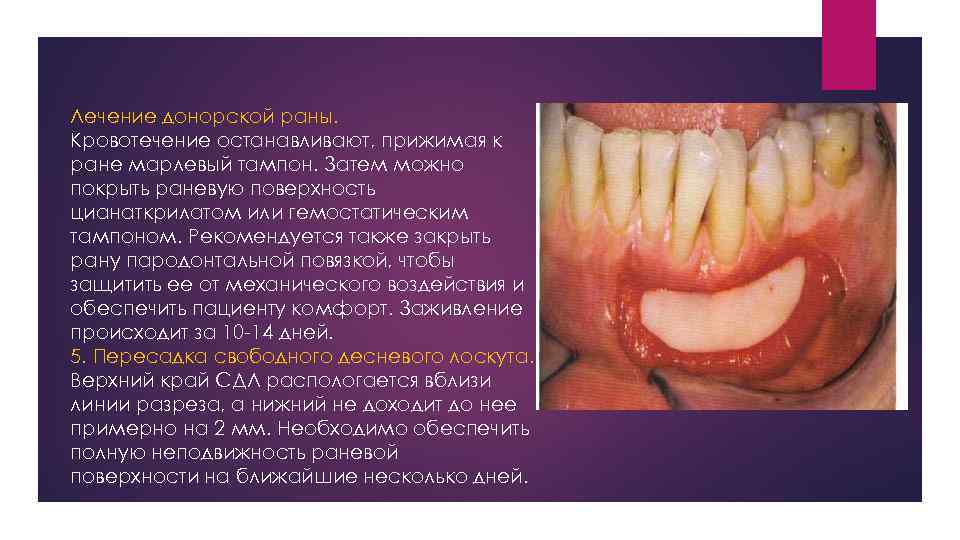Лечение донорской раны. Кровотечение останавливают, прижимая к ране марлевый тампон. Затем можно покрыть раневую